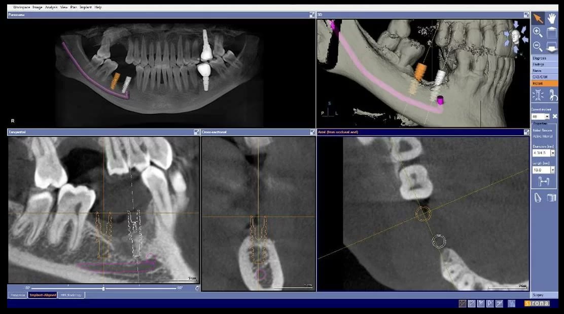 Captură din softul de tomografie: implantul mandibular simulat virtual în zona cu explantări, cu traseul nervului alveolar marcat în roz