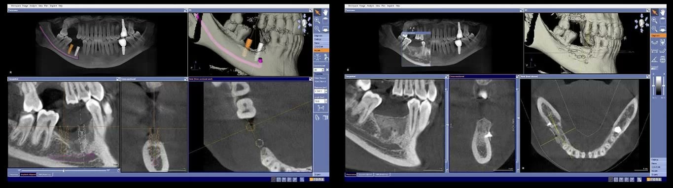 Două capturi din softul de tomografie dentară cu secțiuni prin creasta osoasă, comparate înainte și după refacerea volumului de os