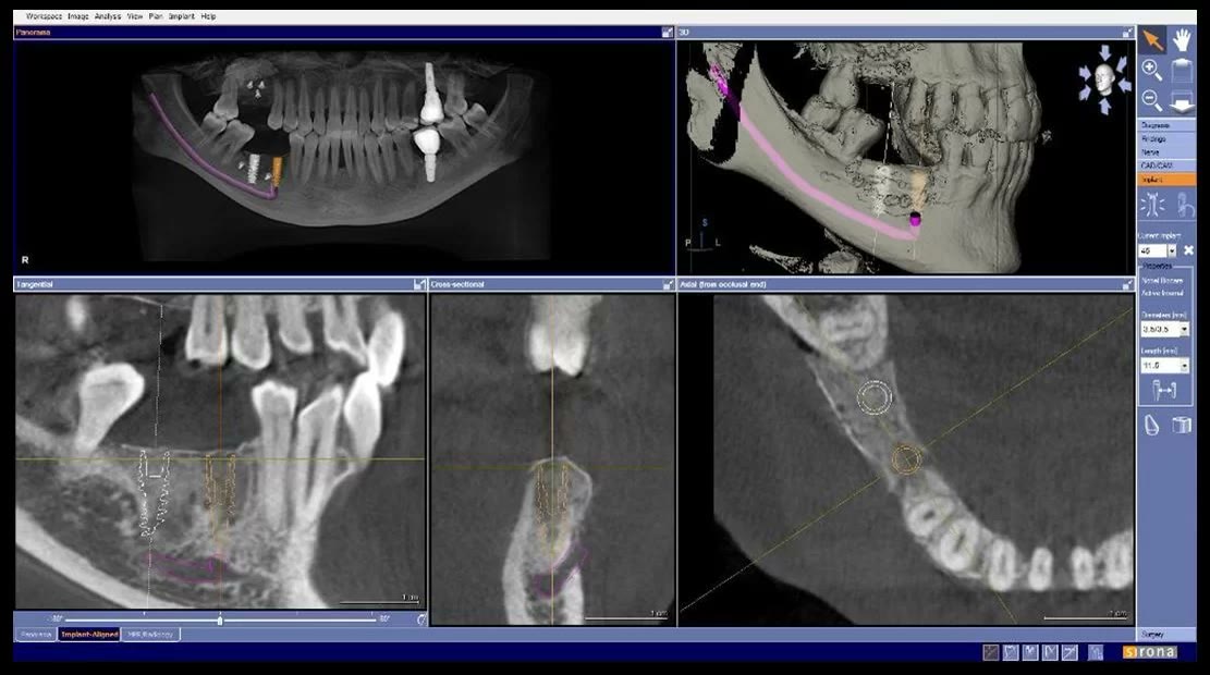 Captură din softul de tomografie cu un al doilea implant mandibular simulat virtual, ancorat în volumul de os refăcut