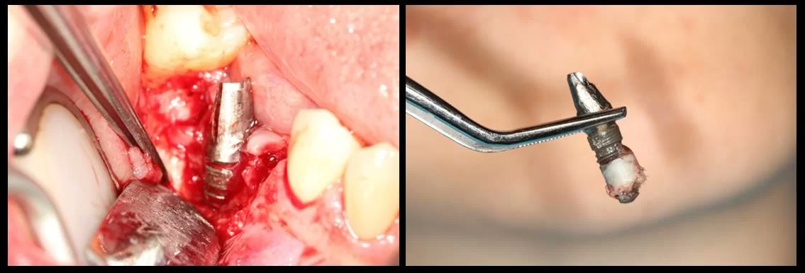Două imagini din timpul explantării: implantul mandibular desprins din os cu instrumentar special și implantul extras, ținut în pensă