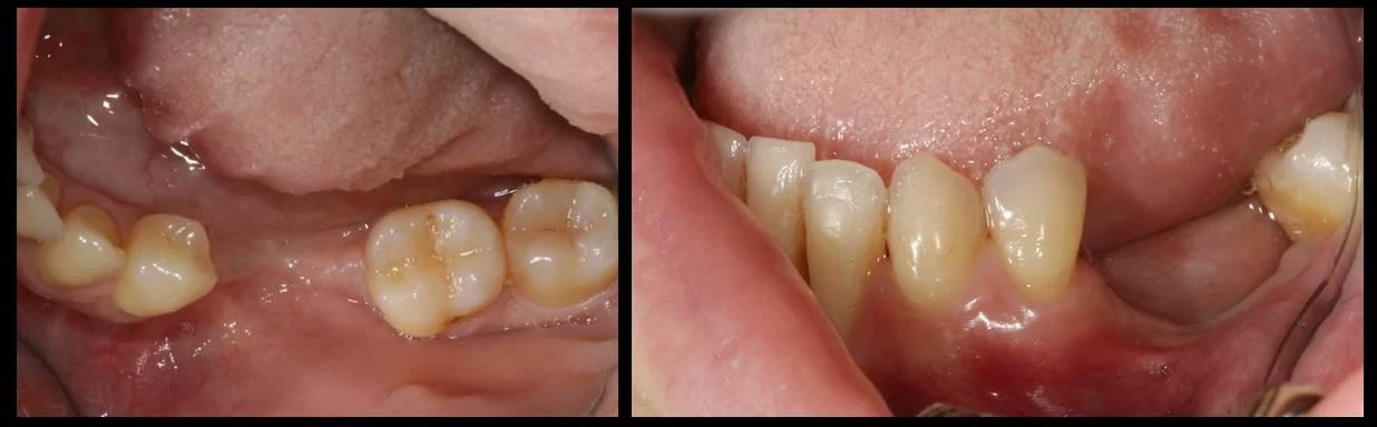 Două fotografii intraorale ale zonei mandibulare vindecate, în care se vede scăderea înălțimii crestei la nivelul gingiei