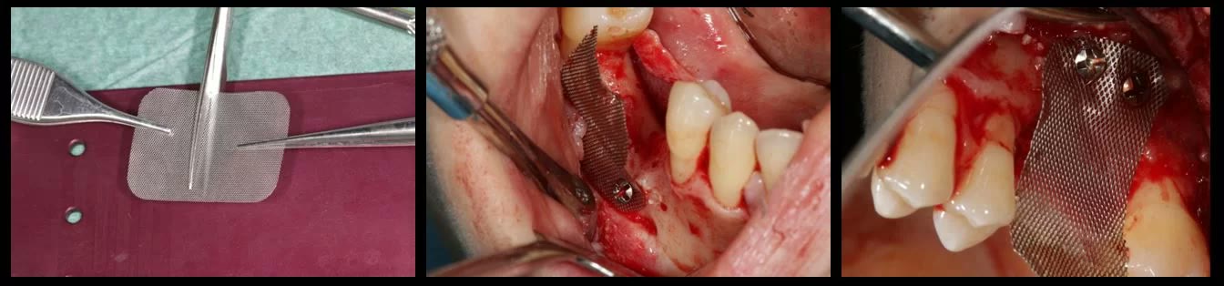 Trei imagini cu plasa din titan: decupată pe masa de instrumentar, adaptată pe creasta osoasă și fixată la os cu șuruburi de osteosinteză