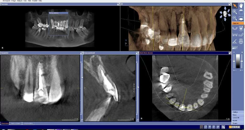Tomografie dentară în softul de planificare: secțiune panoramică, reconstrucție 3D, secțiuni tangențială, transversală și axială în zona incisivilor maxilari dreapta