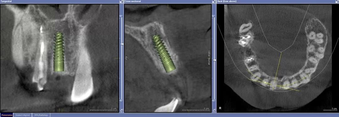 Implantul dentar simulat virtual, marcat cu verde, pe secțiunile tangențială, transversală și axială ale tomografiei dentare