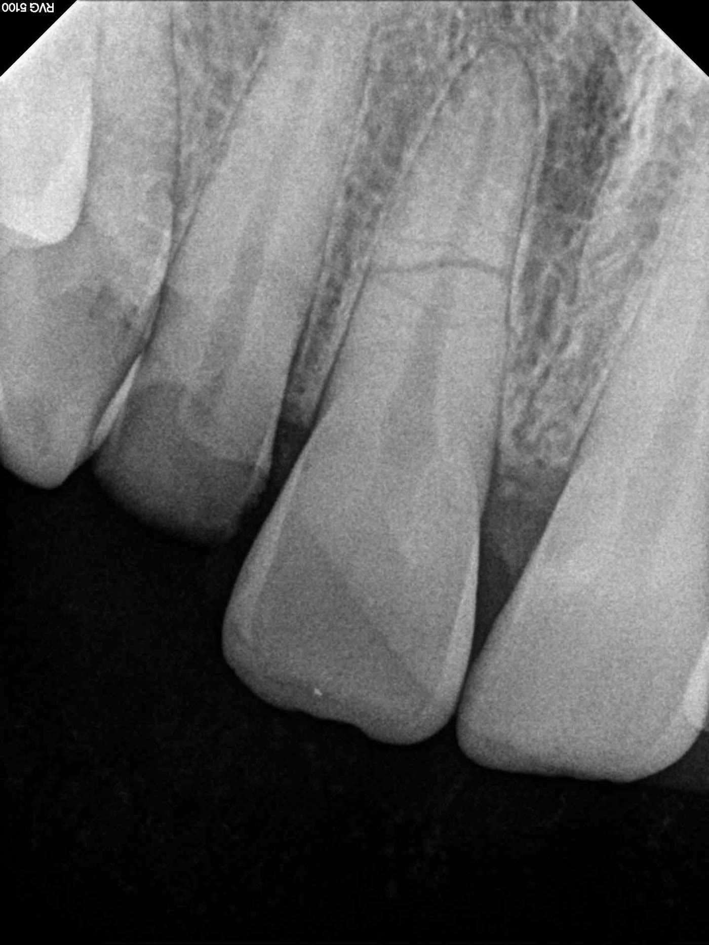 Radiografie retroalveolară a incisivilor maxilari dreapta, cu linia de fractură transversală la nivelul rădăcinii incisivului central