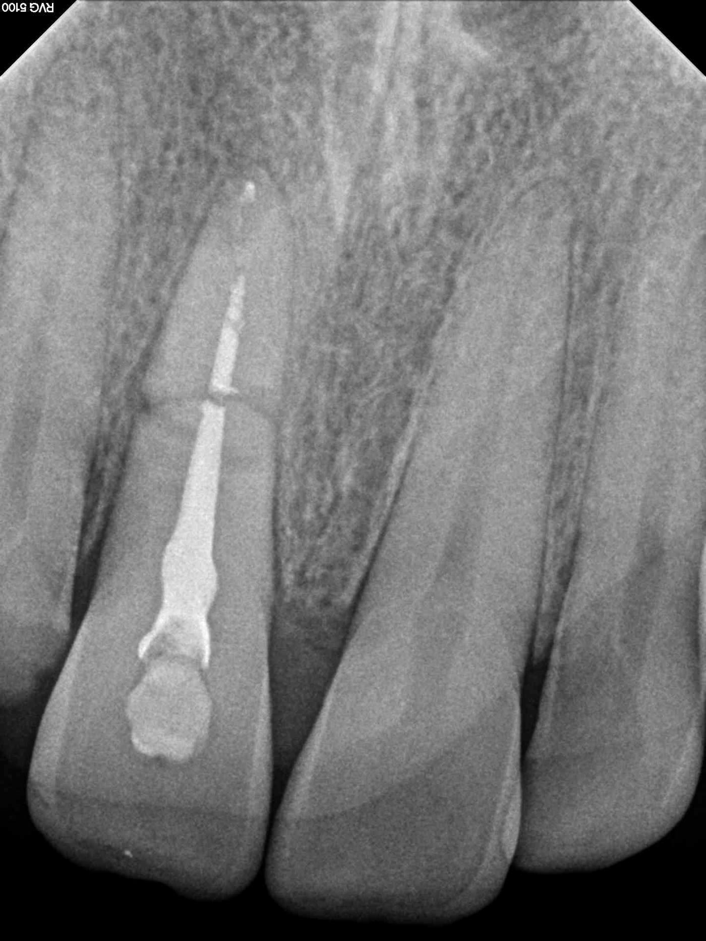 Radiografie retroalveolară pe care se vede canalul radicular obturat al incisivului tratat, alături de zona alveolei incisivului central