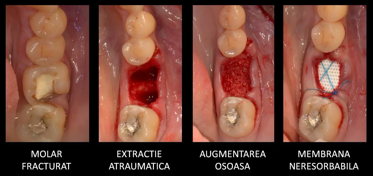 Patru etape clinice intraorale: molarul fracturat, alveolele după extracția atraumatică, augmentarea osoasă și membrana neresorbabilă suturată peste alveole