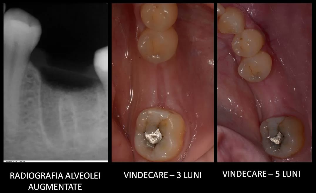 Radiografia alveolei augmentate, alături de aspectul gingiei vindecate la trei luni și la cinci luni de la intervenție
