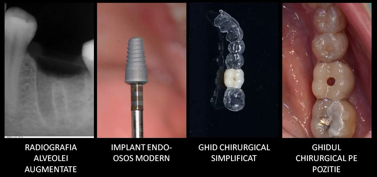 Radiografia alveolei augmentate, implantul endoosos, ghidul chirurgical simplificat transparent și ghidul poziționat pe dinți
