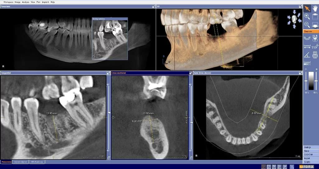 Măsurători efectuate pe tomografia dentară în secțiune tangențială, transversală și axială, în zona molarului extras