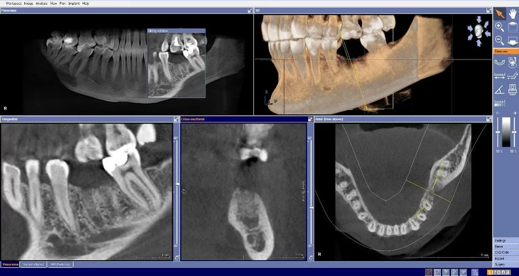 Tomografie dentară a mandibulei în softul de diagnostic, cu secțiune panoramică, reconstrucție 3D, secțiune tangențială, transversală și axială în zona molarului extras