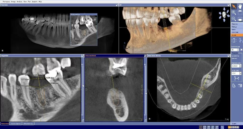 Simularea virtuală a implantului dentar pe tomografie, în softul de planificare, cu axul de inserare marcat în toate planurile