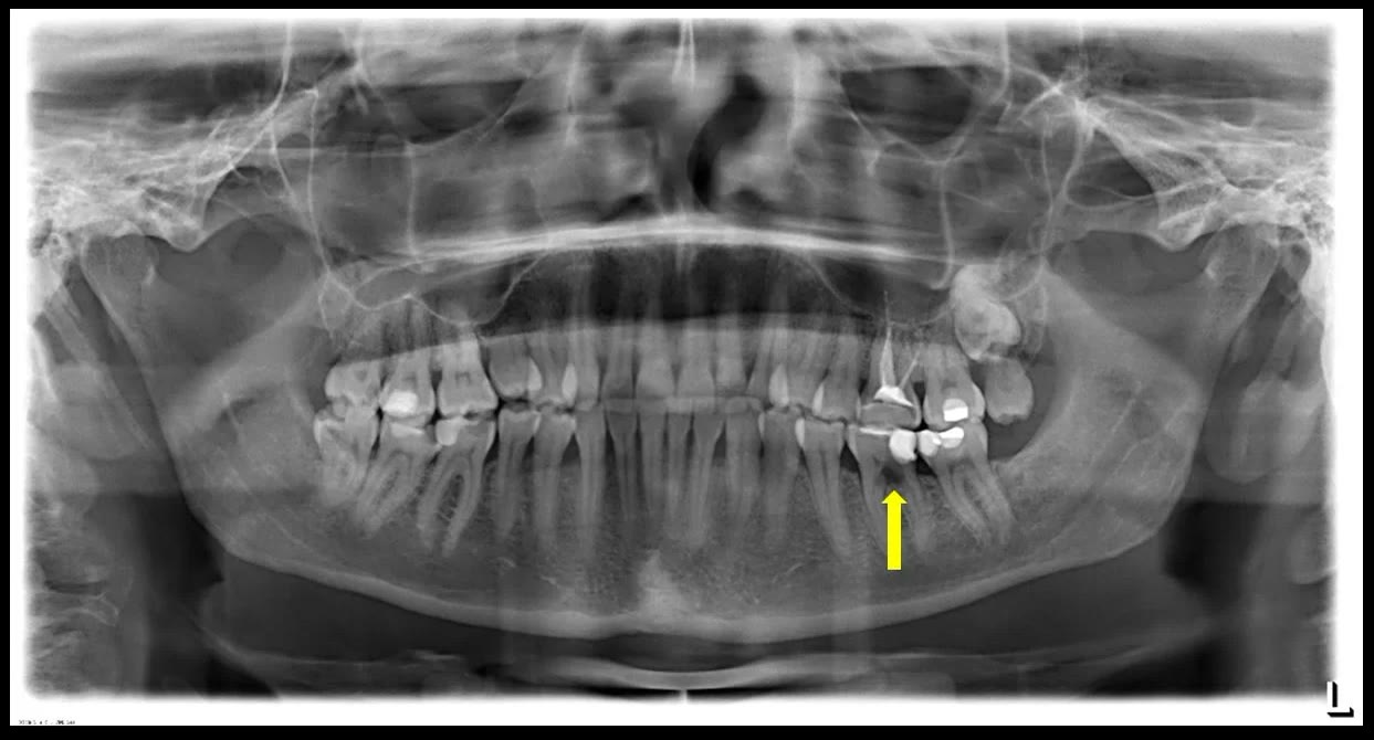 Radiografie panoramică digitală cu o săgeată care indică fractura corono-radiculară a molarului prim inferior stânga