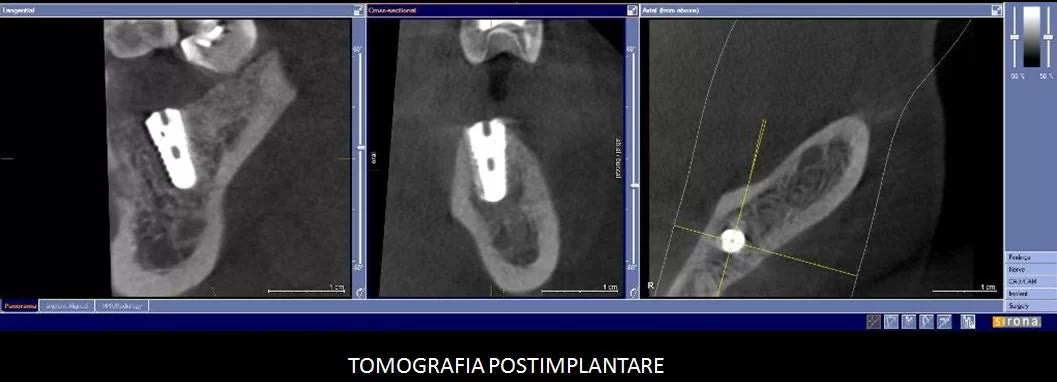 Tomografie dentară de control după inserarea implantului, în secțiune tangențială, transversală și axială