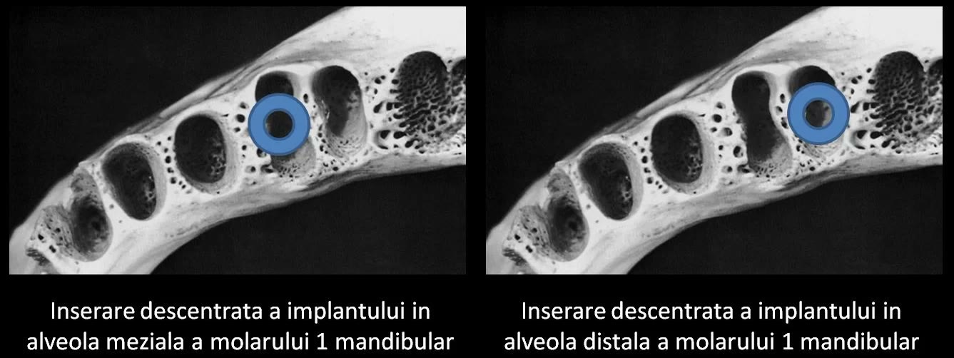 Două secțiuni de mandibulă în care implantul apare inserat descentrat, o dată în alveola mezială și o dată în alveola distală a molarului 1
