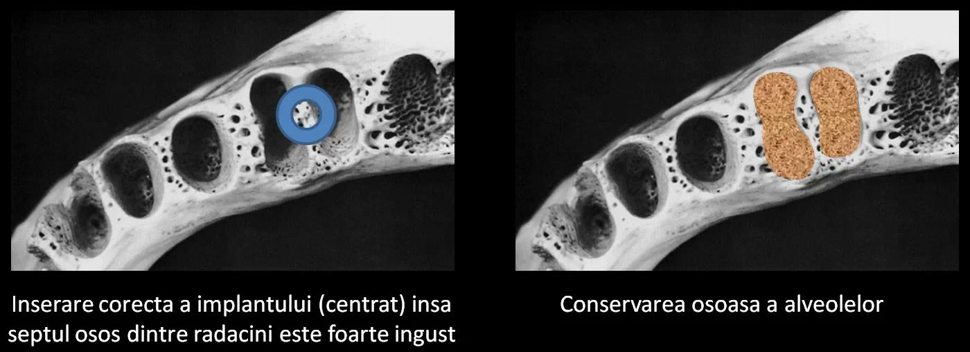 Comparație pe secțiuni de mandibulă: implant centrat pe septul osos subțire dintre cele două alveole și, alături, alveolele umplute cu grefă osoasă