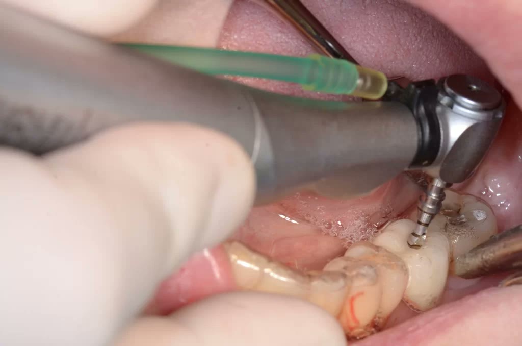 Forajul alveolei implantare prin orificiul ghidului chirurgical, cu răcire, în zona molarului mandibular