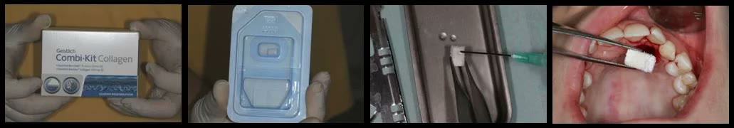 Patru imagini cu materialele de conservare a alveolei: cutia kitului de os substitut cu colagen, ambalajul steril, materialul pregătit pe masa de instrumentar și aplicarea lui în alveolă