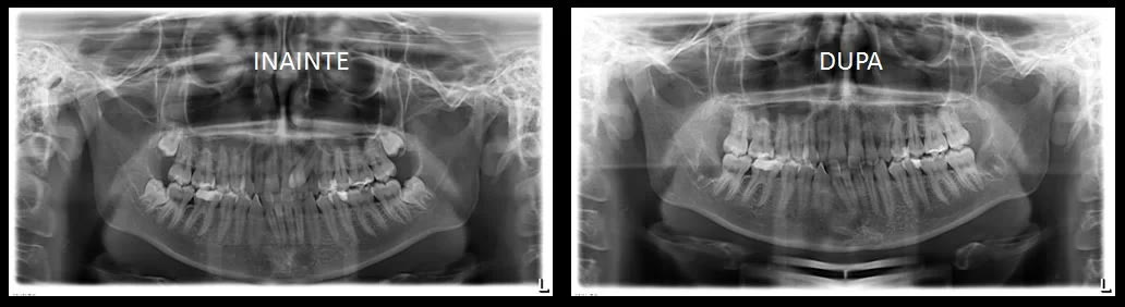 Două radiografii panoramice etichetate „înainte” și „după”: cu cei cinci dinți incluși și, respectiv, după extracția lor