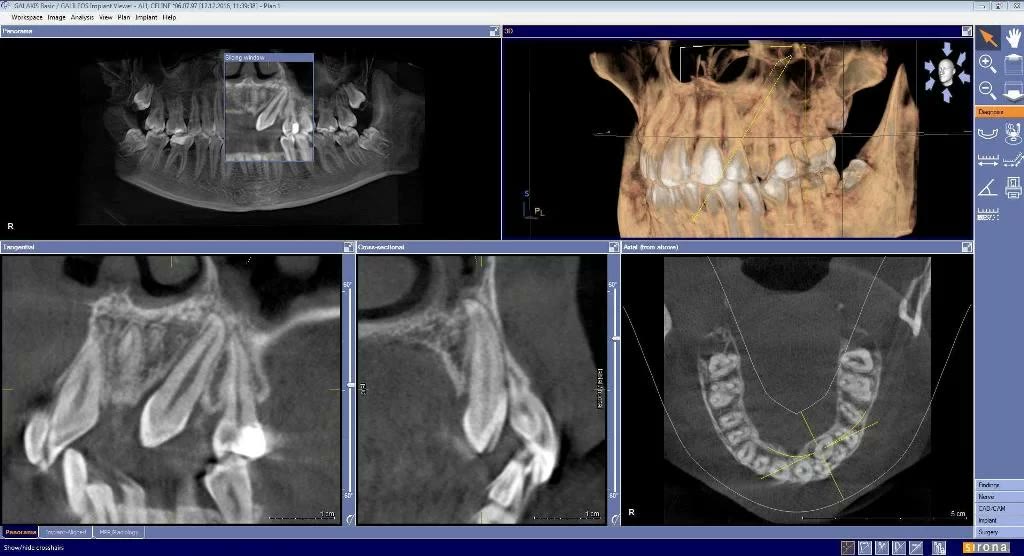 Captură din softul de tomografie dentară cu reconstrucția 3D și secțiunile prin maxilar, care arată caninul inclus și raporturile lui anatomice