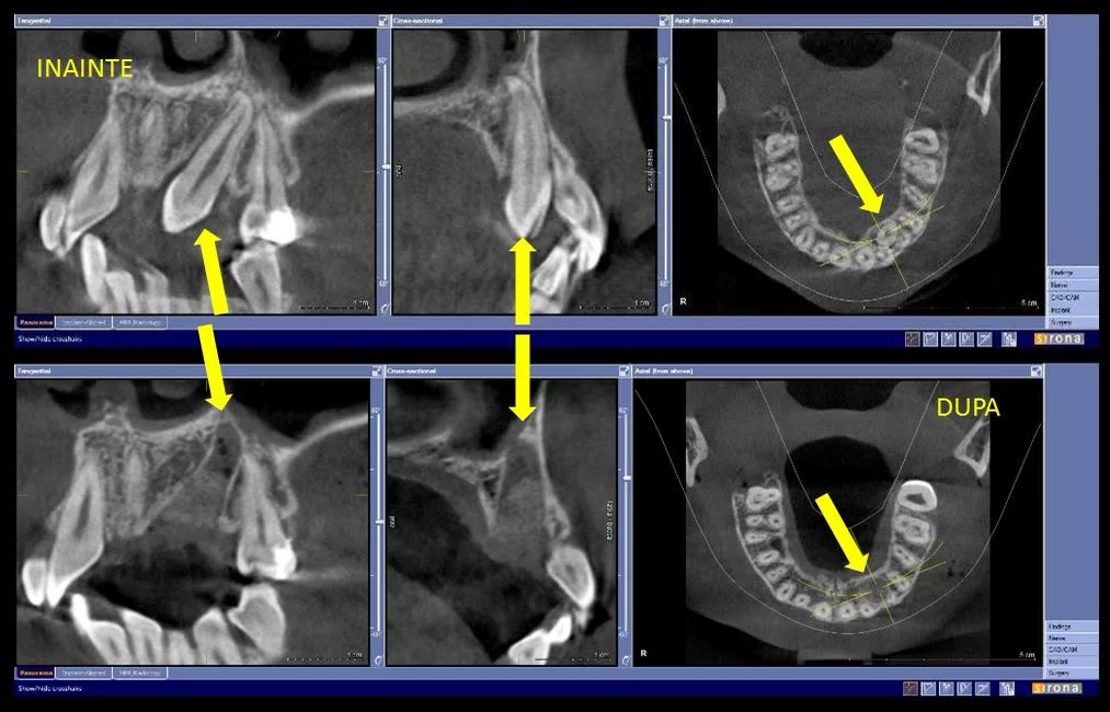 Secțiuni de tomografie dentară etichetate „înainte” și „după”, cu săgeți galbene care indică poziția caninului inclus și, respectiv, zona vindecată după extracție