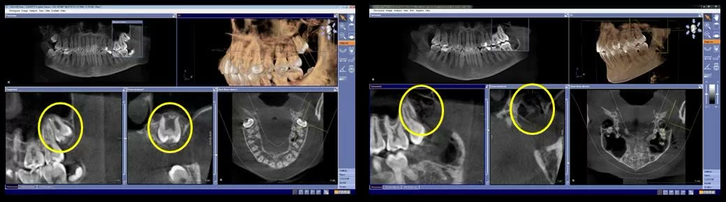 Două capturi din softul de tomografie dentară, cu marcaje galbene: molarul de minte inclus înainte de extracție și zona osoasă după extracție