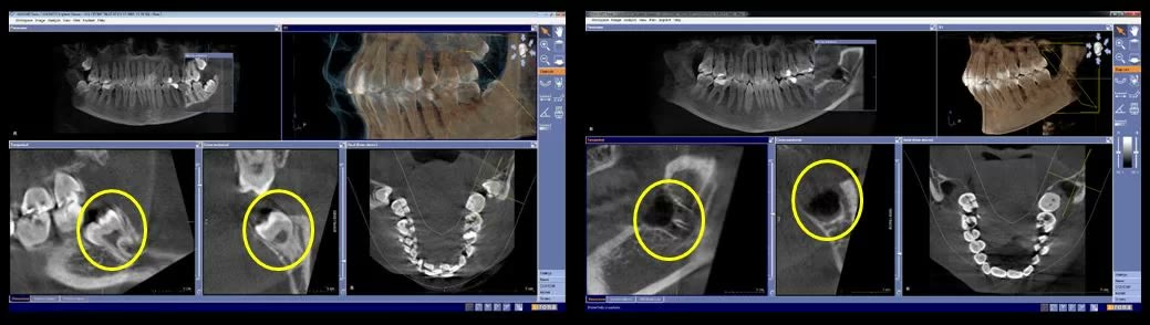 Două capturi din softul de tomografie dentară, cu marcaje galbene care compară un molar de minte blocat în os și spațiul osos rămas după extracție
