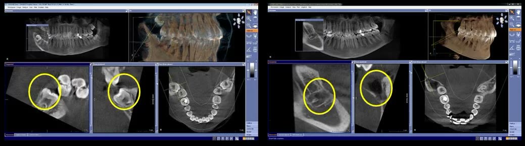 Două capturi din softul de tomografie dentară, cu marcaje galbene pe molarul de minte inclus și, comparativ, pe alveola rămasă după extracție
