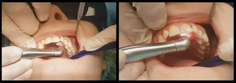 Două imagini intraorale cu piesa de mână a laserului chirurgical folosită pentru secționarea gingiei din bolta palatină, în jurul caninului inclus