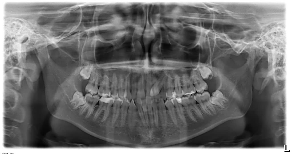 Radiografie panoramică digitală pe care se văd cei patru molari de minte rămași incluși în os, la maxilar și la mandibulă