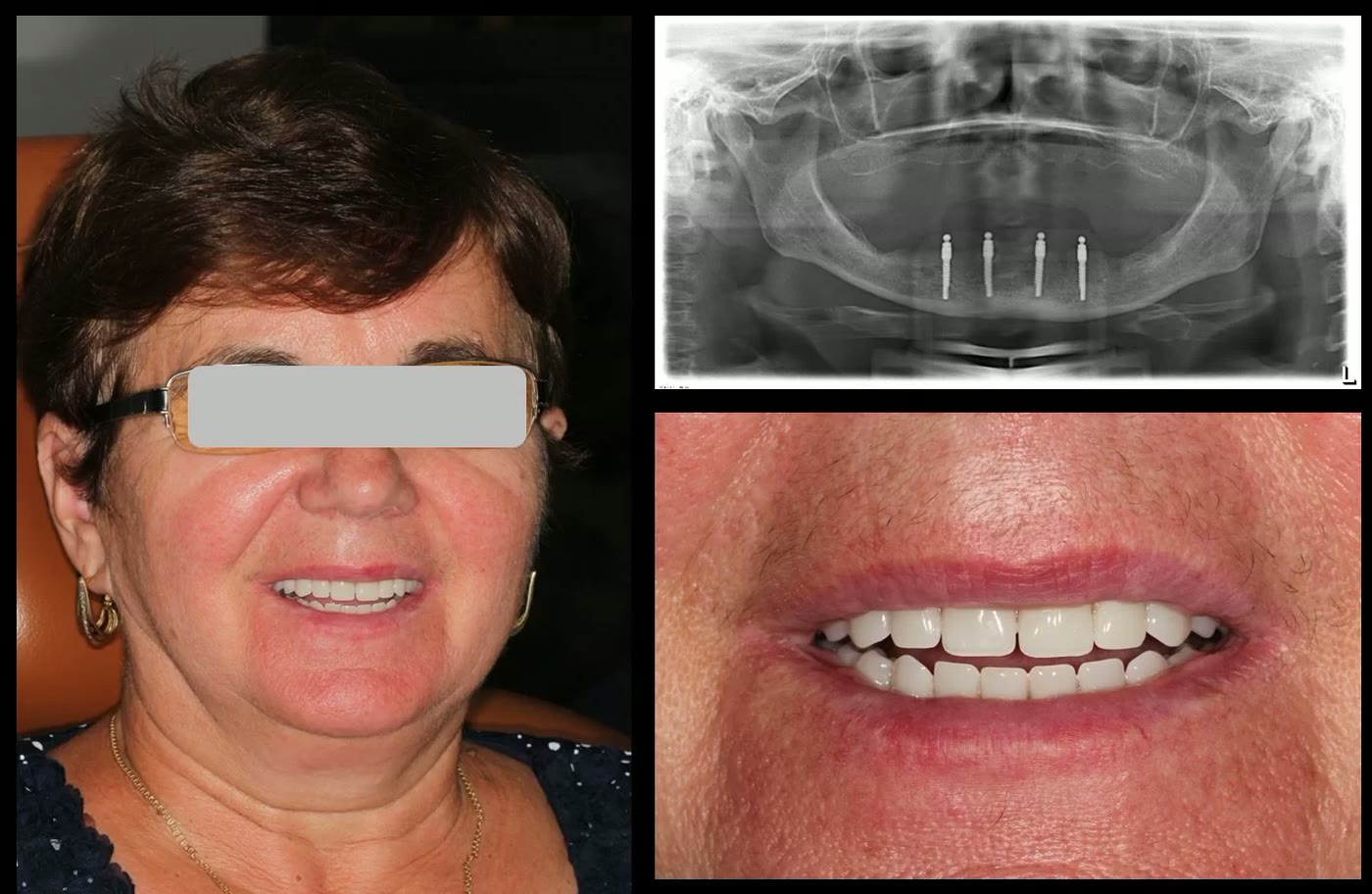 Pacientă cu proteză mobilizabilă pe miniimplanturi: fotografia zâmbetului și radiografia panoramică cu cele 4 miniimplanturi mandibulare