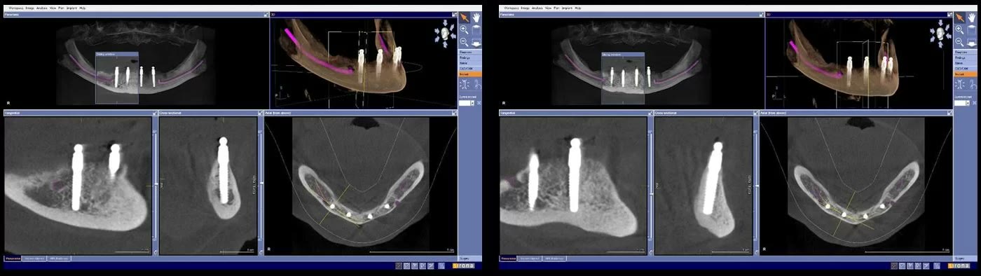 Două capturi din softul de tomografie de control, cu secțiuni prin partea dreaptă a mandibulei, care arată miniimplanturile ancorate în os, la distanță de traseul nervului marcat în roz