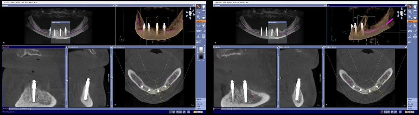 Două capturi din softul de tomografie de control, cu secțiuni prin partea stângă a mandibulei, care arată miniimplanturile bine centrate în creasta osoasă