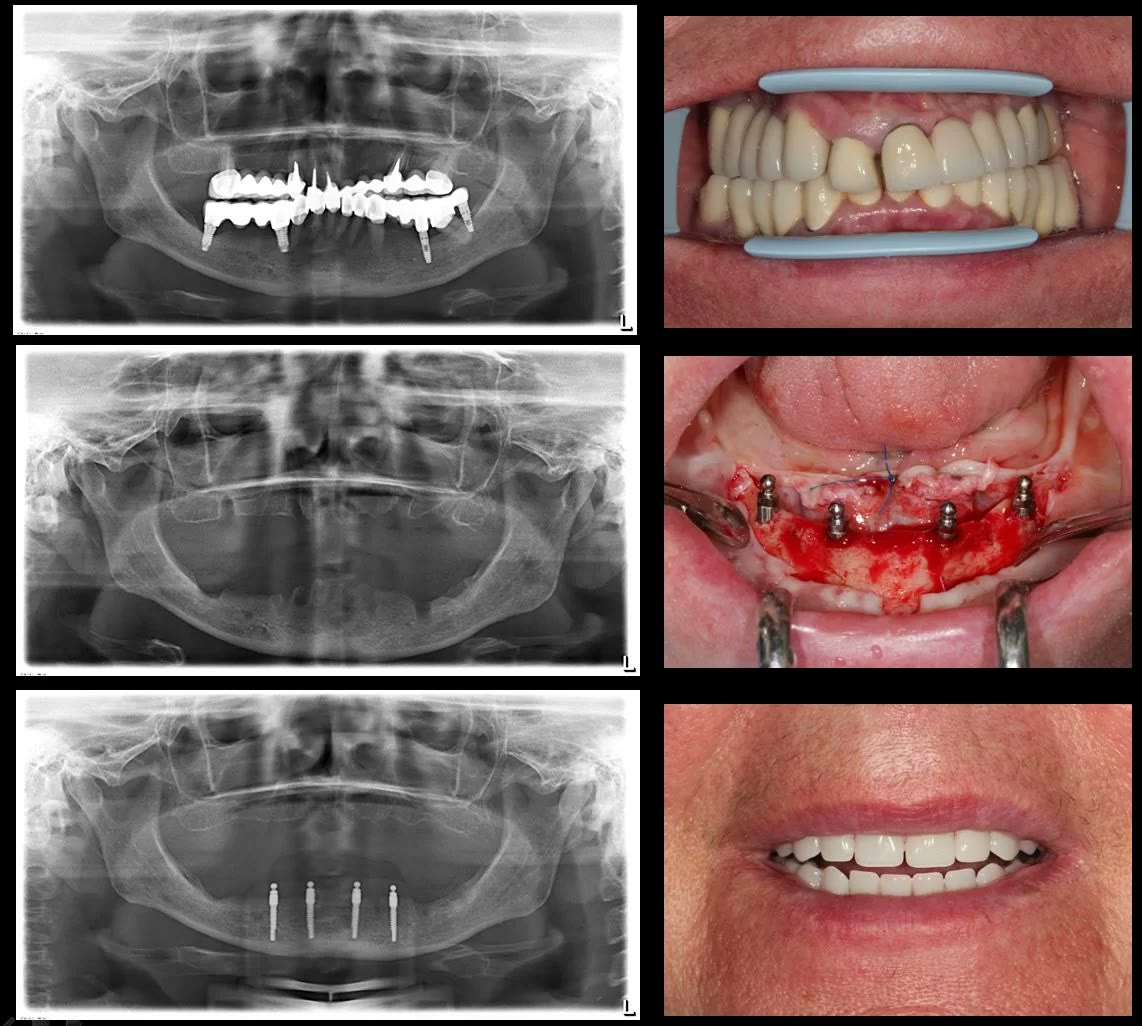 Șase imagini alăturate: radiografia panoramică inițială cu lucrarea veche, cea de după extracții și explantări, cea cu cele patru miniimplanturi, plus fotografiile clinice corespunzătoare, până la proteza finală