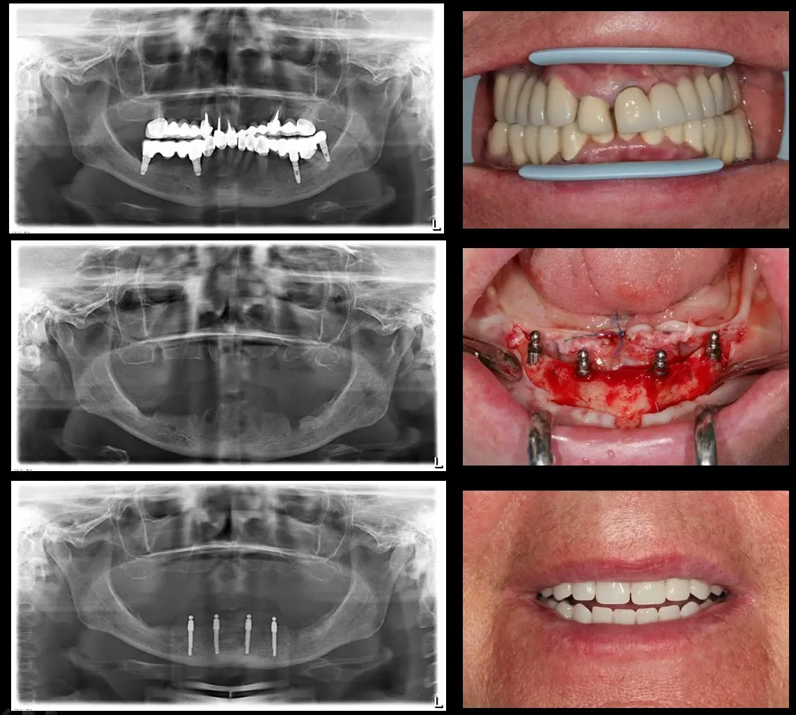 Șase imagini alăturate: radiografia panoramică inițială cu lucrarea veche, cea de după extracții și explantări, cea cu cele patru miniimplanturi, plus fotografiile clinice corespunzătoare, până la proteza finală
