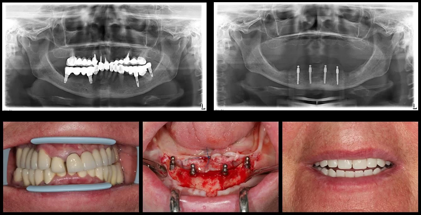 Radiografia panoramică inițială și cea cu cele patru miniimplanturi mandibulare, alături de trei fotografii: dantura compromisă, miniimplanturile inserate și proteza finală