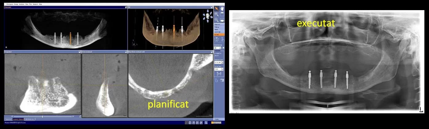 În stânga, planificarea virtuală a miniimplanturilor în softul de tomografie, marcată „planificat”; în dreapta, radiografia panoramică finală, marcată „executat”