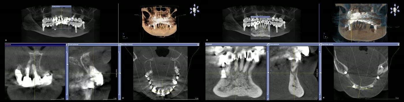 Două capturi din softul de tomografie dentară, cu secțiuni prin maxilar și mandibulă, în care se văd zonele de os afectat din jurul vârfurilor rădăcinilor și al implanturilor