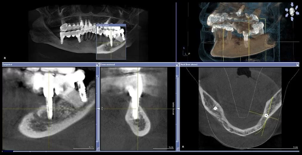 Captură din softul de tomografie dentară cu secțiuni prin mandibulă, în care vârful implantului ajunge la nivelul canalului nervului alveolar inferior