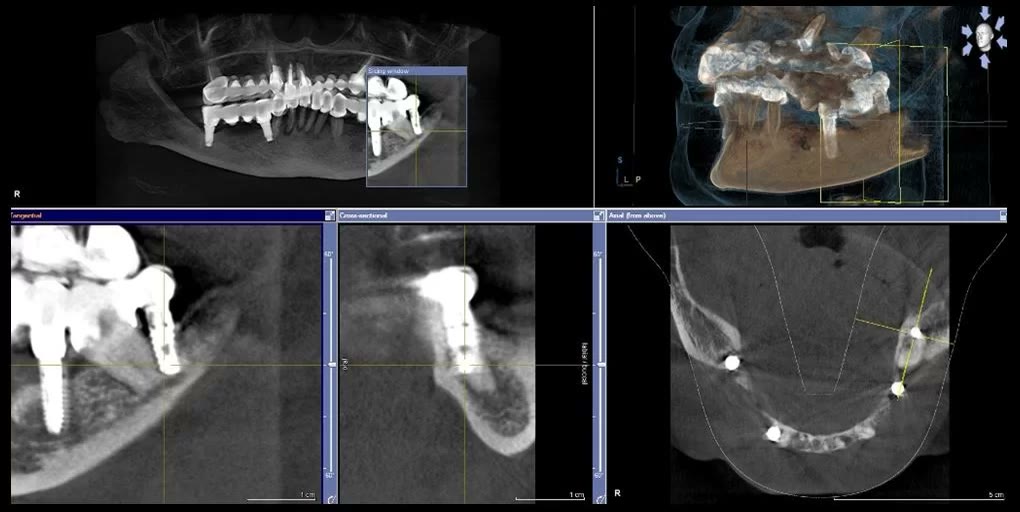 Captură din softul de tomografie dentară în care implantul apare suprapus pe rădăcina dintelui natural vecin
