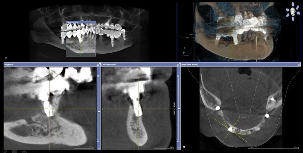 Captură din softul de tomografie dentară în care o mare parte a implantului se află în afara conturului osos al crestei