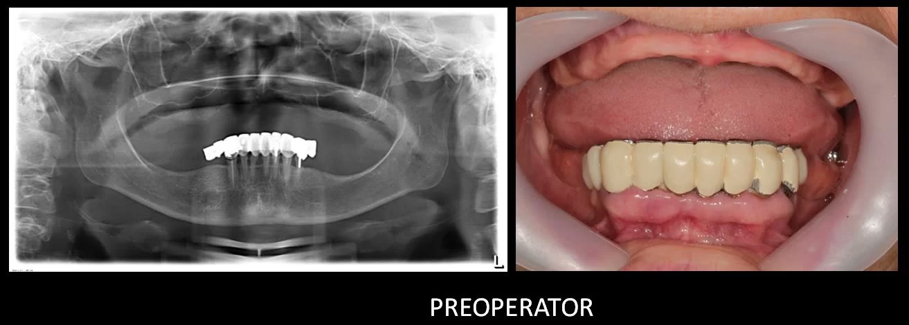 Preoperator: radiografia panoramică cu maxilarul superior edentat și fotografia intraorală cu dinții mandibulari degradați