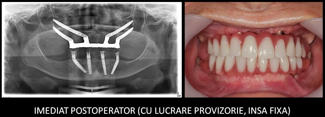 Imediat postoperator: radiografia panoramică cu implanturile inserate și fotografia lucrărilor provizorii, fixe
