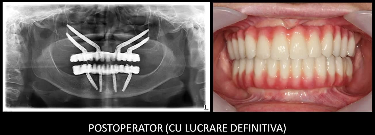 Postoperator, cu lucrarea definitivă: radiografia panoramică de control și fotografia intraorală a arcadelor