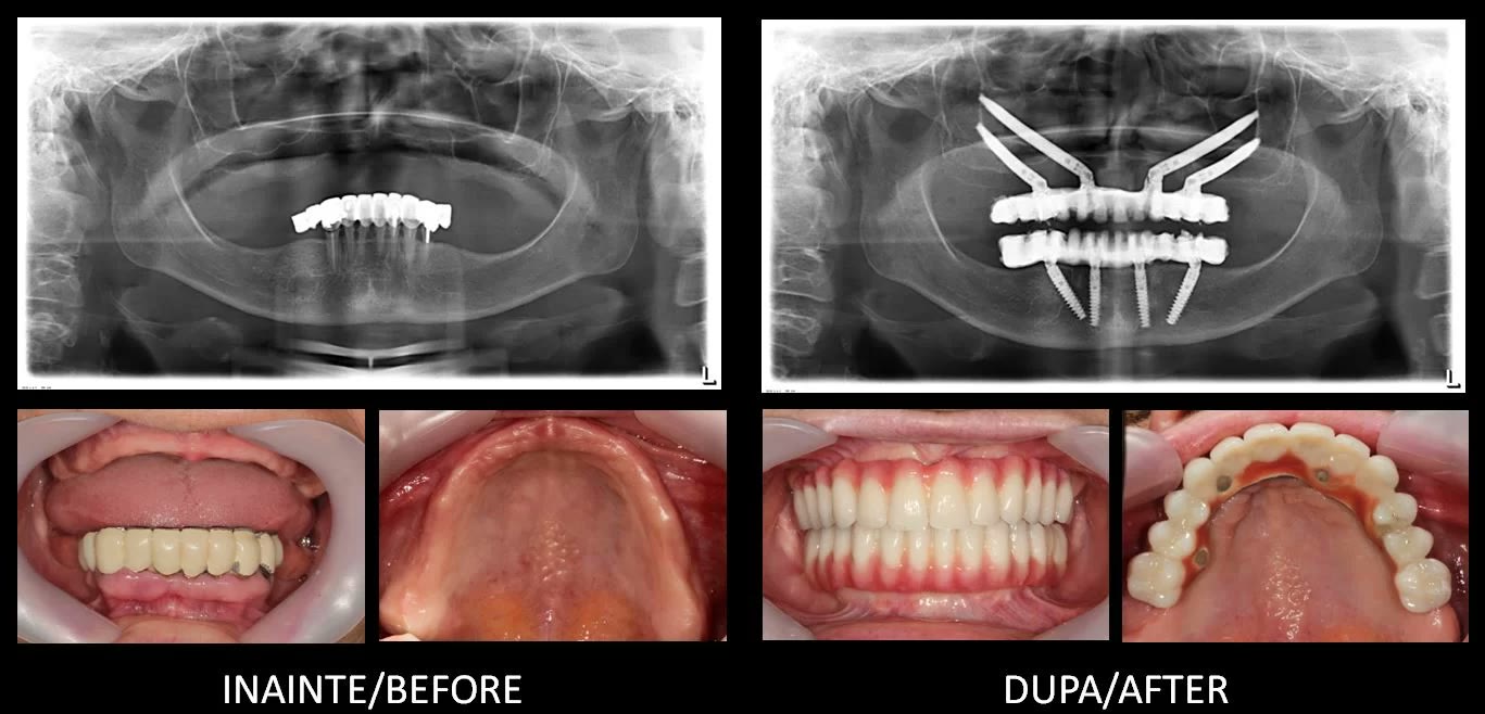Comparație înainte și după: radiografii panoramice și fotografii intraorale ale unei paciente reabilitate cu 4 implanturi zigomatice la maxilar