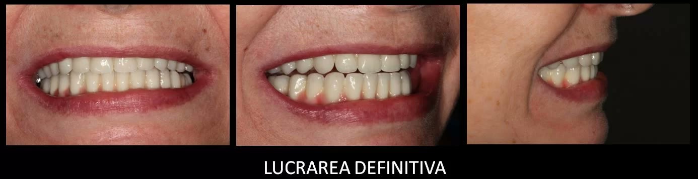 Zâmbetul cu lucrările definitive, fotografiat din față și din trei sferturi
