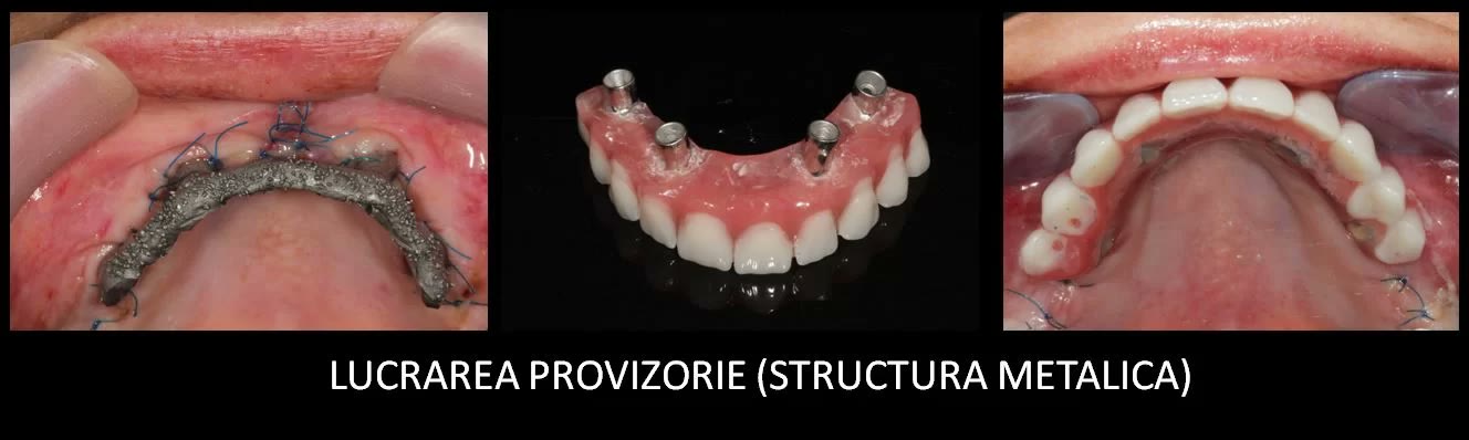 Lucrarea provizorie cu structură metalică: cadrul fixat în gură, lucrarea finalizată în laborator și montată pe implanturi