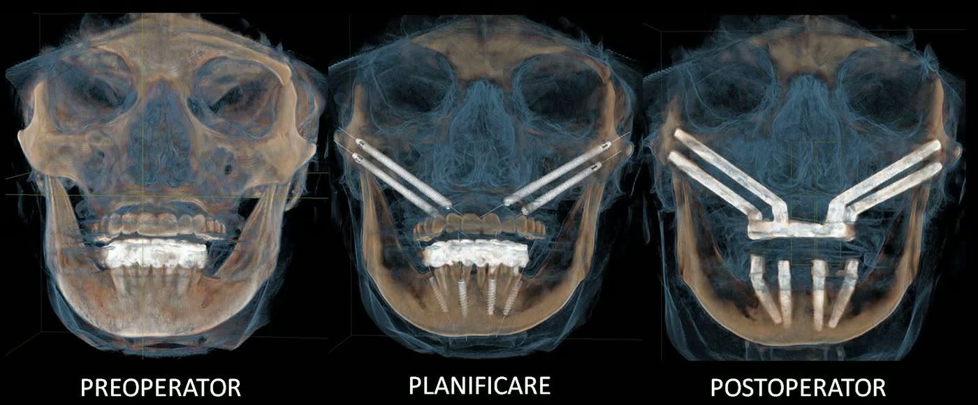 Trei reconstrucții tridimensionale din tomografia dentară: situația preoperator, planificarea implanturilor și rezultatul postoperator