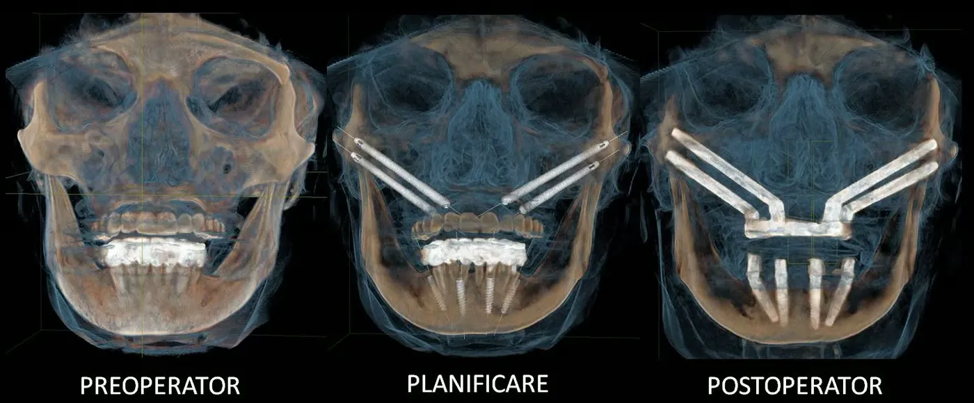 Trei reconstrucții tridimensionale din tomografia dentară: situația preoperator, planificarea implanturilor și rezultatul postoperator