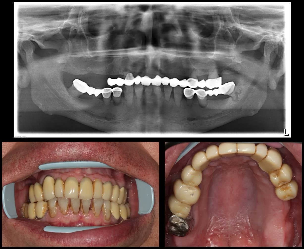 Radiografia panoramică digitală de la prezentare, alături de fotografiile diagnostice: dinții afectați parodontal și puntea totală de la maxilar